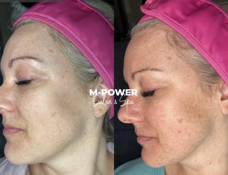 IPL treatment before and after at M-Power Salon & Spa