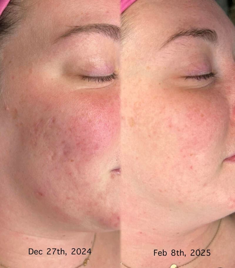 Microneedling before and after at M-Power Salon & Spa